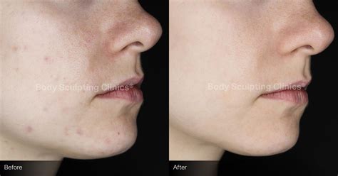 body sculpting northbridge|Skin Needling .